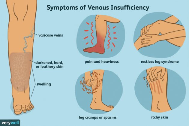 Understanding Chronic Venous Insufficiency Senior News And Living 1476