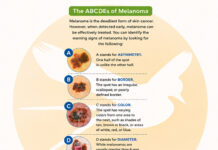 Melanoma – Know the Signs