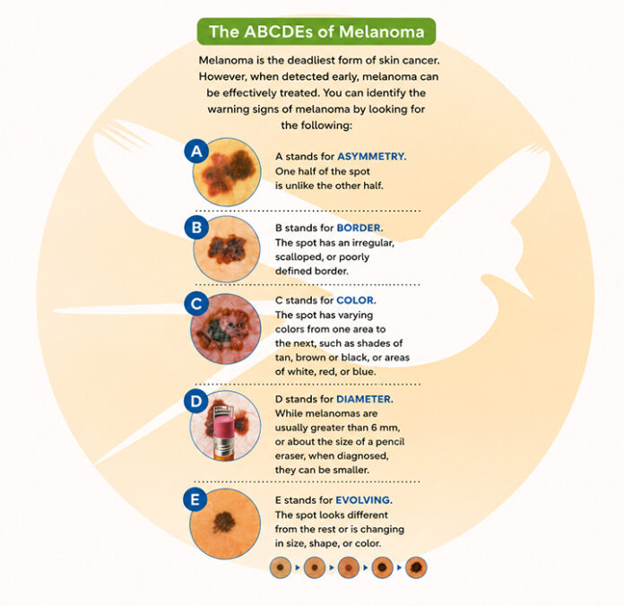 melanoma graphic